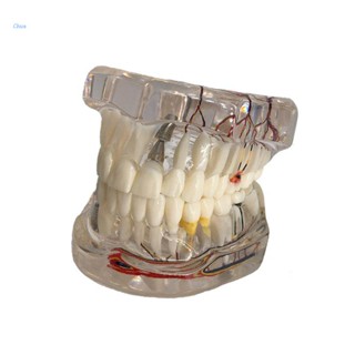 Chua Dental Disease Implant Teeth Model with Restoration Bridge Tooth Dentist for Med