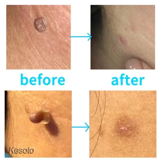 อุปกรณ์กำจัดหูด ไฝ ติ่งเนื้อ หลุดออกอย่างง่ายดาย Medical Skin Tag Kill Remover
