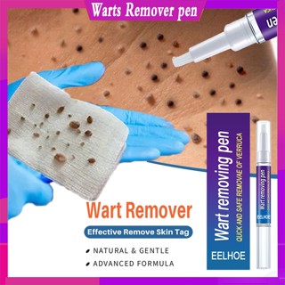 Warts ปากกาลบไฝ รักษาไฝ สําหรับร่างกาย