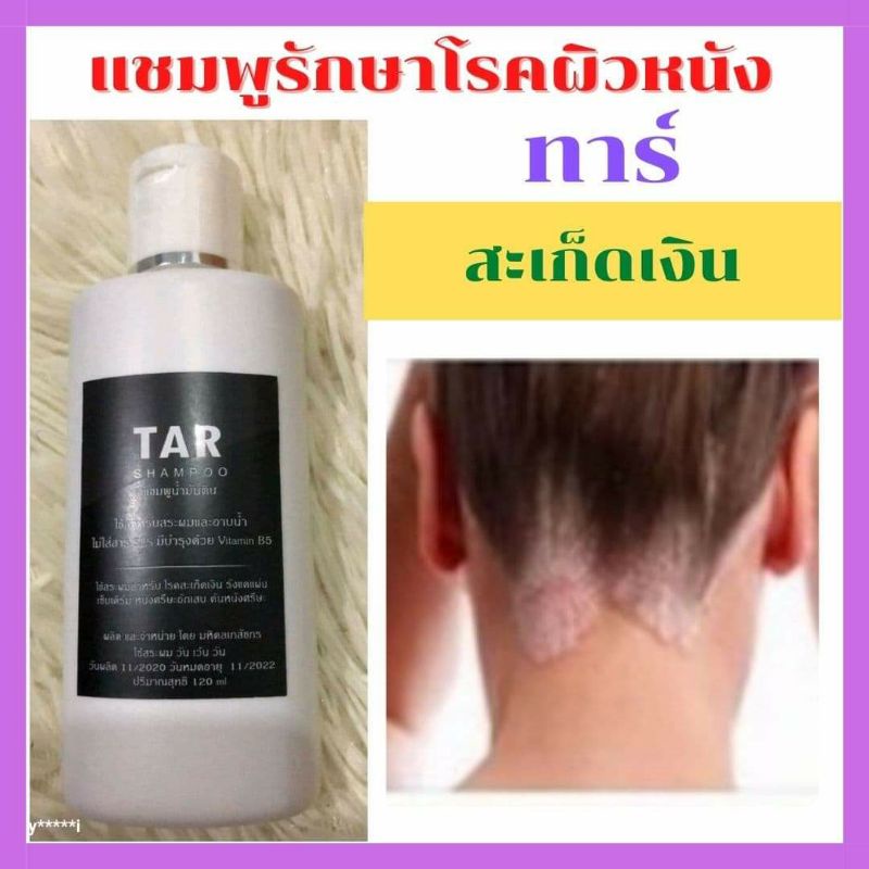 Tar Shampoo ทาร์แชมพู แชมพูรักษาโรคผิวหนัง แชมพูน้ำมันดิน โรคสะเก็ดเงิน เชื้อรา เซบเดิร์ม อาการคัน รังแค (120 มล.)