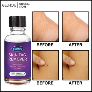 10/20/30/50มล.EELHOE Mole &amp; Skin Tag Removal Solution ไม่เจ็บปวด Mole Skin Dark Spot Removal Face Wart Tag Removal Skin Wart-Like Removal Agent-Eelhoe