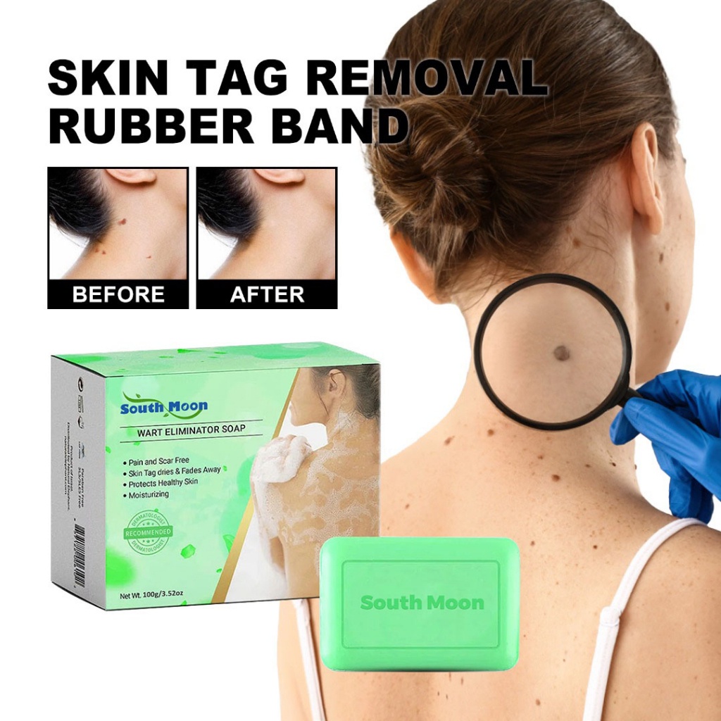 Wart Eliminator Soap Natural Aloe Vera Softening Skin Blemish Removal