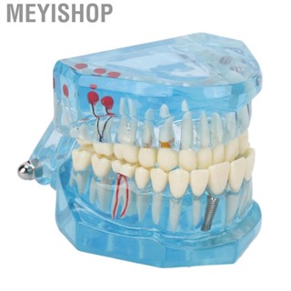 Meyishop Dental Pathological Model Clear Teaching Detachable  Display B