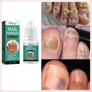 South Moon Nail Fungus Solution Repair Thickening Yellow Ingrown Onychomycosis Toenail Essence Non-irritating Treatment Body Nail Care 10ml JOYFEEL ซื้อทันที เพิ่มลงในรถเข็น