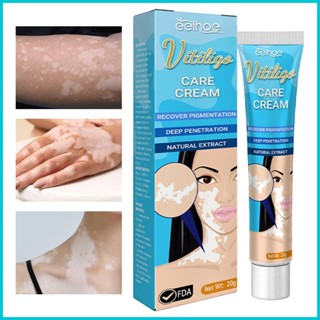 Vitiligo ครีมบํารุงผิว 20 กรัม บรรเทาจุดด่างดําบนผิว และกําจัดผิวหนัง ง่ายต่อการขัดฟัน