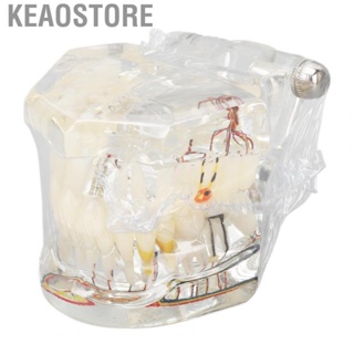 Keaostore Disease  Model Portable Acrylic Teaching  Implant  Model for Clinic  Pathological Model Transparent