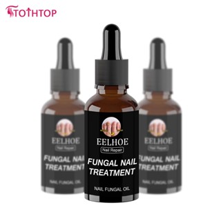 Onychomycosis Nail Foot Toe Nail Fungus Removal Gel Care Drop Fungal Treatment Repair Serum 30ml/50ml [ด้านบน]