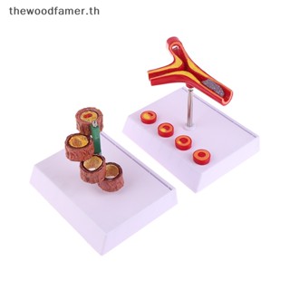 Atherosclerosis รูปปั้นมนุษย์ 50 เท่า สําหรับห้องแล็บ