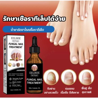 (กำจัดเชื้อราที่เล็บ) น้ำยารักษาโรคเชื้อราที่เล็บ 30ml