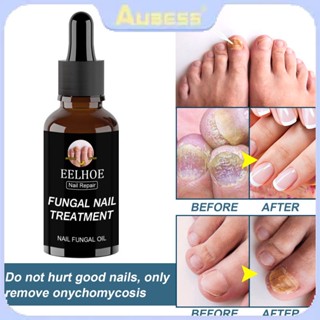 Eelhoe Antibacterial Nail Treatment Essential Anti Fungal Infection Toe พยาบาลป้องกันการติดเชื้อ Paronychia Onychomycosis TECH3