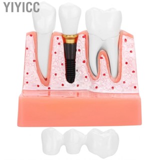 Yiyicc Model Dental Implant Analysis Crown Bridge Demonstration Tooth