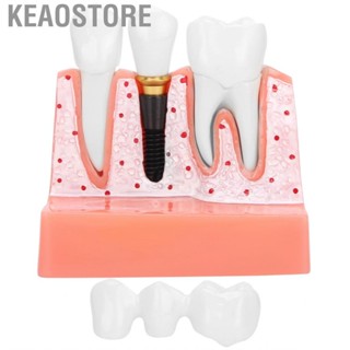 Keaostore Model Dental Implant Analysis Crown Bridge Demonstration Tooth