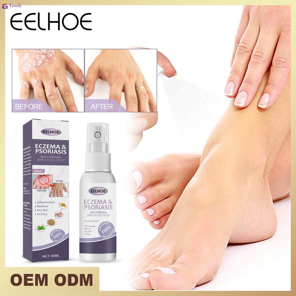 Tinea Pedis สเปรย์ ยารักษาโรคกลาก 30mlหนังศีรษะ โรคสะเก็ดเงิน มือ เท้า กลิ่นเกลื้อน ยับยั้งเชื้อรา ป