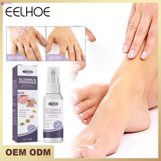 Tinea Pedis สเปรย์ ยารักษาโรคกลาก 30mlหนังศีรษะ โรคสะเก็ดเงิน มือ เท้า กลิ่นเกลื้อน ยับยั้งเชื้อรา ป้องกันอาการคัน
 【goob】