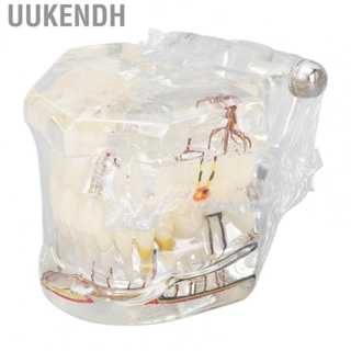 Uukendh Disease  Model Portable Acrylic Teaching  Implant  Model for Clinic  Pathological Model Transparent