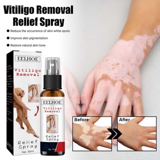 30ml EELHOE White Spot Repair Spray Antibacterial Vitiligo Treatment Serum Leukoplakia Disease Pigment Melanin Repair Body Face Care