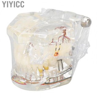 Yiyicc Disease  Model Portable Acrylic Teaching  Implant  Model for Clinic  Pathological Model Transparent