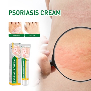 Tiktok hot# West &amp; Month anti-itching cream skin anti-Moss external itching mosquito bites hands and feet itching blisters anti-itching cream 8vv