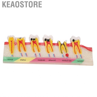 Keaostore Dental Caries Developing Model Decayed  For Teaching Study