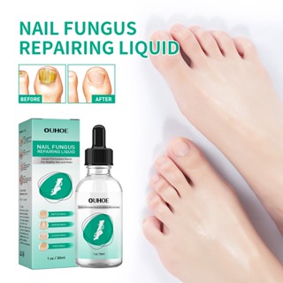 in stock#OUHOE toenail repair solution thickened hand and foot gray nail soft nail repair solution brightening nail cleaning repair solution 7/10