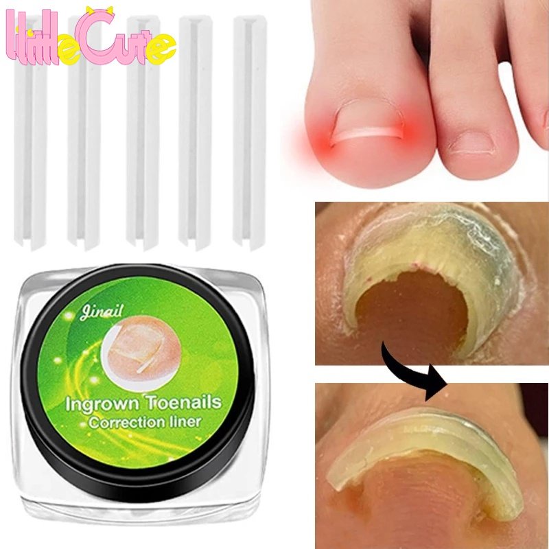 [แนะนํา]เครื่องมือแก้ไขเล็บเท้าคุดมืออาชีพ 10 ชิ้น / แผ่นแก้ไขเล็บเท้าคุด/ เครื่องมือดูแลเท้า