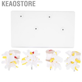 Keaostore 4‑Stage Human Spine Model Lumbar Vertebrae Normal Pathological Models with Base