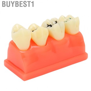 Buybest1 Dental Implant Disease Study Teaching  Model Restoration Bridge Tooth Analy