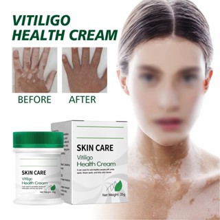 Enjoy Beauty Vitiligo Care Cream ลดจุดขาวปรับปรุงผิวสี Moisturizing 35g