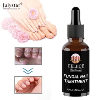 JULYSTAR Eelhoe Nail Fungus Repair Treatment Essence 50ml การรักษาเชื้อรา Paronychia โซลูชั่นการรักษาเล็บ