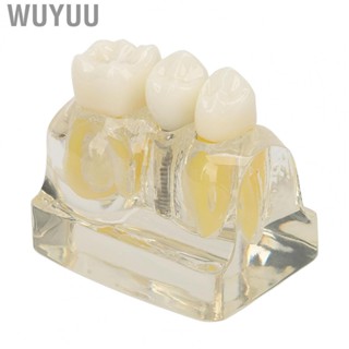 Wuyuu Implant Tooth Model   Implant Model Teaching Accuracy  for Patients for Demonstration