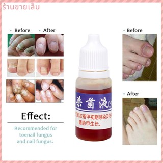 10Ml Nail Fungus Treatment Original Nail Anti Fungal Treatment ครีมทาเล็บ Onychomycosis Remover Serum Nailshop Store