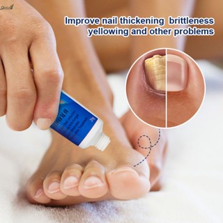 ครีมกำจัดเล็บ Onychomycosis Nail Treatment Nail Groove Toe Nail Care Ointment Onychomycosis Soft Nail Removal Ointm qccuot