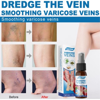 Mild Varicose Vein Treat สเปรย์นวดเส้นเลือดขอด อเนกประสงค์ สําหรับผู้หญิง ผู้ชาย