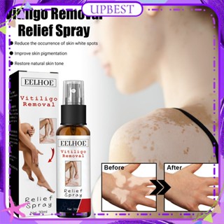 ♕Eelhoe Vitiligo Removal Relief Spray Repair White Spot Desalination Sweat Spot Moisturizing Skin Improve Skin Pigmentation Body Care 30Ml UPBEST