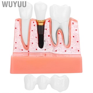 Wuyuu Model Dental Implant Analysis Crown Bridge Demonstration Tooth