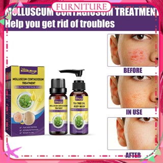 ♕ South Moon Molluscum Contagiosum Treatment Kit Removal Common Warts Plantar Warts Meat Thorn Skin Tag Dispel Kit Natural Herbal Treatment Body Care เฟอร์นิเจอร์