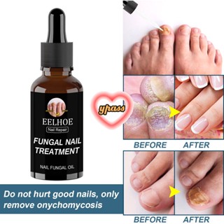 CYREAL CYREAL Eelhoe Nail Fungus Treatment Liquid Repair Liquid ซึมซาบเร็วส่งเสริมการเจริญเติบโตของเล็บที่แข็งแรง