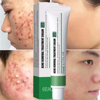 Effective Acne Removal Cream Acne Treatment Fade Acne Spots Oil Control Shrink Pores Whitening Moisturizing