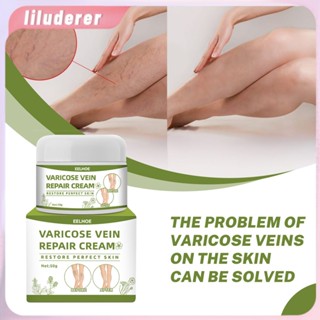 Eelhoe Vein Repair Cream สามารถบรรเทาความเจ็บปวดของเส้นเลือดขอดที่ขาโดยการขุดลอกหลอดเลือดดำ HO