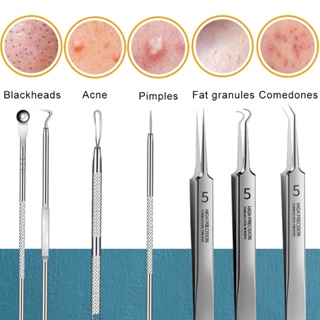 5 ชิ้น สเตนเลส กําจัดสิว ชุดกําจัดสิวเสี้ยน สิวเสี้ยน กําจัดสิวเสี้ยน เข็ม ทรีตเมนต์ เครื่องมือดูแลผิวหน้า