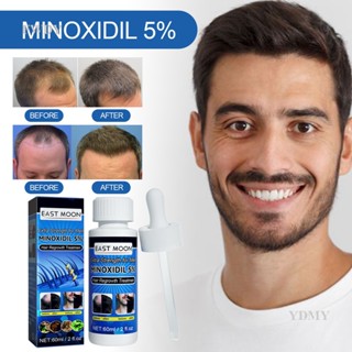 Fengwunineday Minoxidil น้ํามันเร่งการเจริญเติบโตของเส้นผม 5% ต่อต้านการหลุดร่วงของเส้นผม สําหรับผู้ชาย