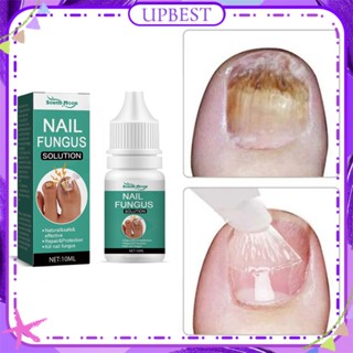 ♕ South Moon Nail Fungus Solution Repair Thickening Yellow Ingrown Onychomycosis Toenail Essence Anti-bacteria Treatment Body Care 10ml UPBEST