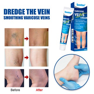 【สินค้าพร้อม】20g Sumifun Varicose Veins Remover มีประสิทธิภาพ Original Varicose Veins Remover สำหรับขา