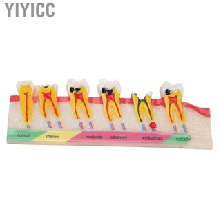 Yiyicc Dental Caries Developing Model Decayed  For Teaching Study