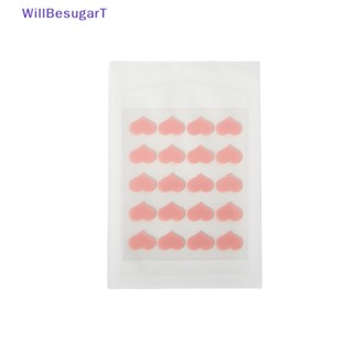 [WillBesugarT] แผ่นพลาสเตอร์ ควบคุมสิว ดูแลผิวหน้า 20 ชิ้น [ใหม่]