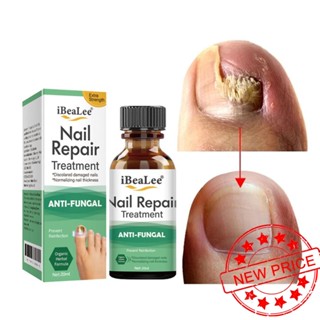 Onychomycosis ครีมรักษาเชื้อราเล็บ 20 มล. J6V1