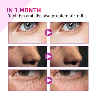 Speedy Milia Remover Milia Spot Treatment Helps Dissolve &amp; Reduce Milia