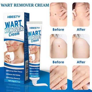 HBESTY Wart Remover Cream 20g Skin Warts&amp;Plaques&amp;Nevi Traceless Care