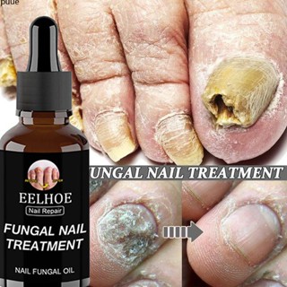 Eelhoe Nail Fungus Treatment Liquid Repair Liquid puueqg