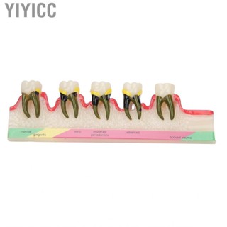 Yiyicc Dental Model  Study Decoration Professional Demonstration Learning